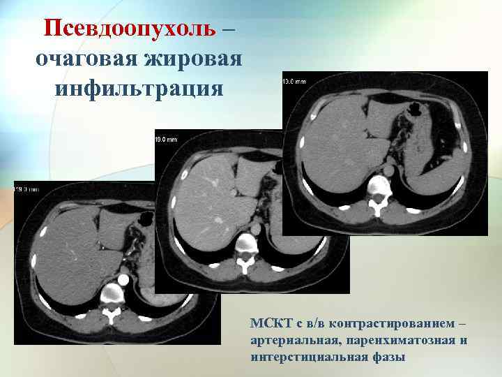 Псевдоопухоль – очаговая жировая инфильтрация МСКТ с в/в контрастированием – артериальная, паренхиматозная и интерстициальная