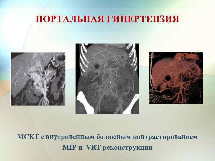 ПОРТАЛЬНАЯ ГИПЕРТЕНЗИЯ МСКТ с внутривенным болюсным контрастированием MIP и VRT реконструкции 