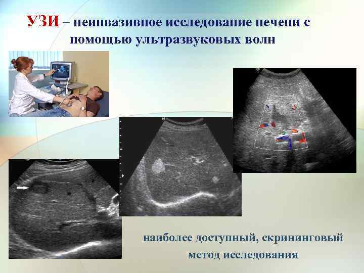 УЗИ – неинвазивное исследование печени с помощью ультразвуковых волн наиболее доступный, скрининговый метод исследования