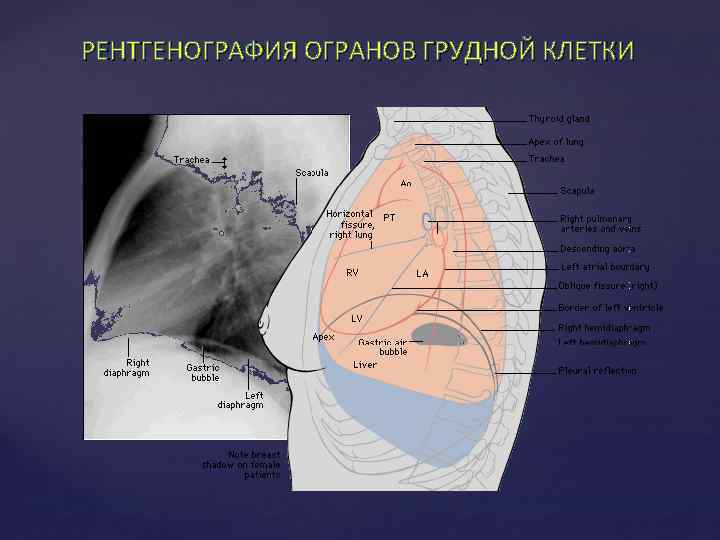 РЕНТГЕНОГРАФИЯ ОГРАНОВ ГРУДНОЙ КЛЕТКИ 