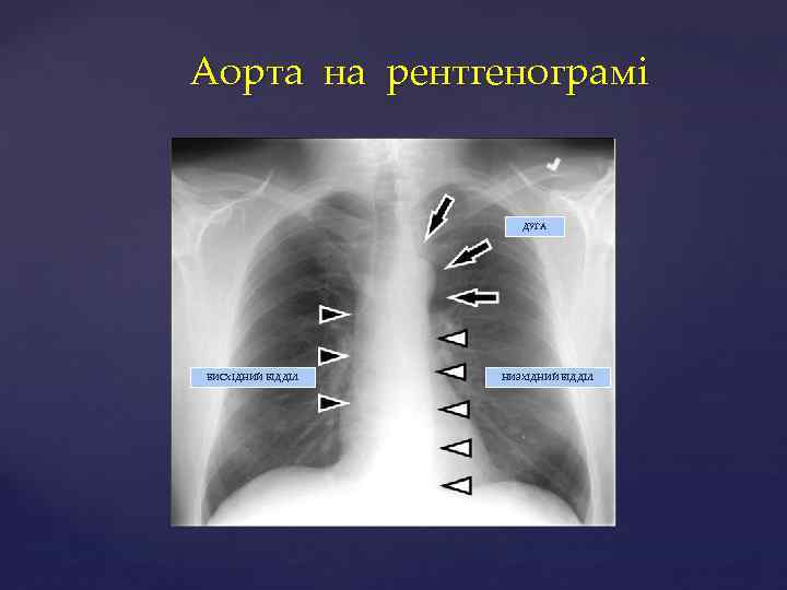 Аорта на рентгенограмі ДУГА ВИСХІДНИЙ ВІДДІЛ НИЗХІДНИЙ ВІДДІЛ 