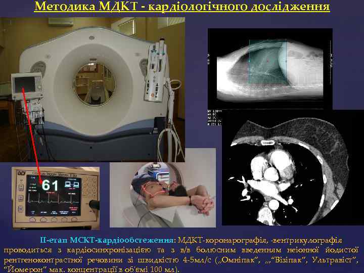 Методика МДКТ - кардіологічного дослідження ІІ-етап МСКТ-кардіообстеження: МДКТ-коронарографія, -вентрикулографія проводиться з кардіосинхронізацією та з