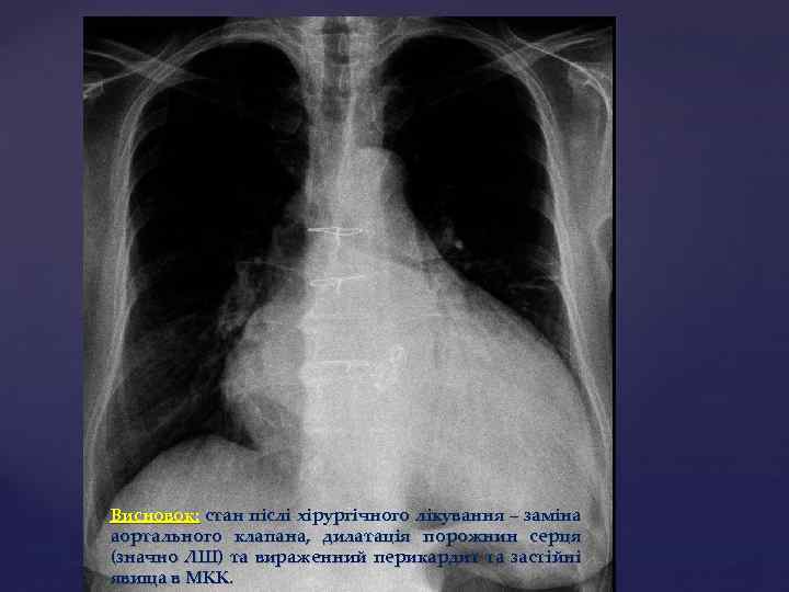 Висновок: стан післі хірургічного лікування – заміна аортального клапана, дилатація порожнин серця (значно ЛШ)