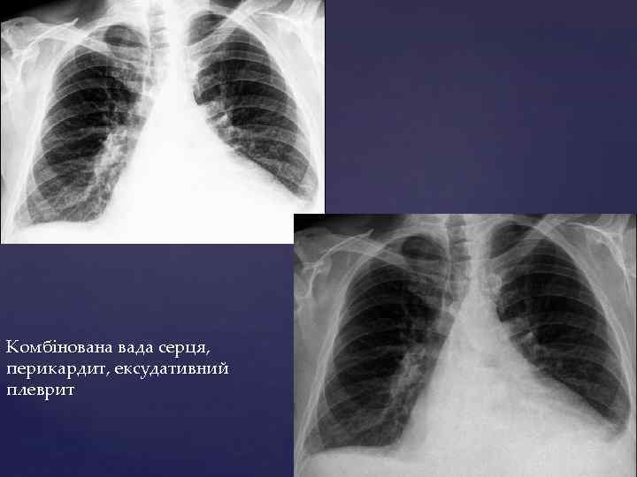 Комбінована вада серця, перикардит, ексудативний плеврит 