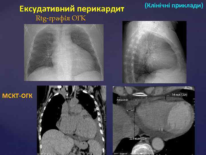 Ексудативний перикардит Rtg-графія ОГК МСКТ-ОГК (Клінічні приклади) 