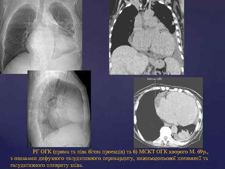 РГ ОГК (пряма та ліва бічна проекція) та б) МСКТ ОГК хворого М. 69