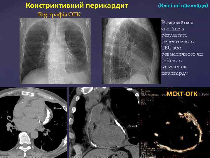 Констриктивний перикардит (Клінічні приклади) Rtg-графія ОГК Розвивається частіше в результаті перенесеного ТВС, або ревматичного