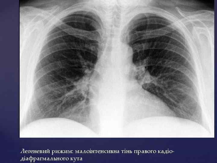 Легеневий рижим: малоінтенсивна тінь правого кадіодіафрагмального кута 