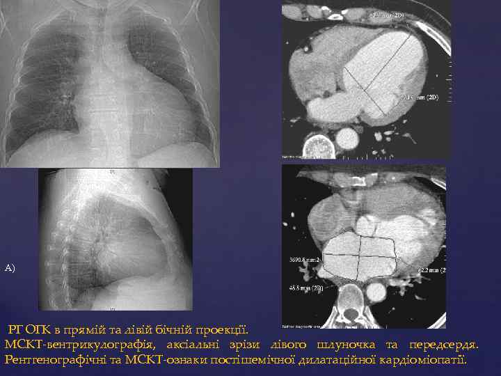 А) РГ ОГК в прямій та лівій бічній проекції. МСКТ-вентрикулографія, аксіальні зрізи лівого шлуночка