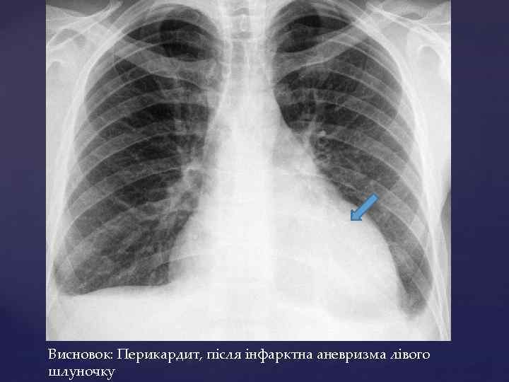 Висновок: Перикардит, після інфарктна аневризма лівого шлуночку 