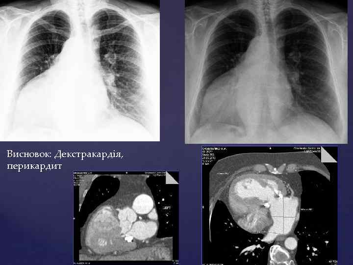 Висновок: Декстракардія, перикардит 