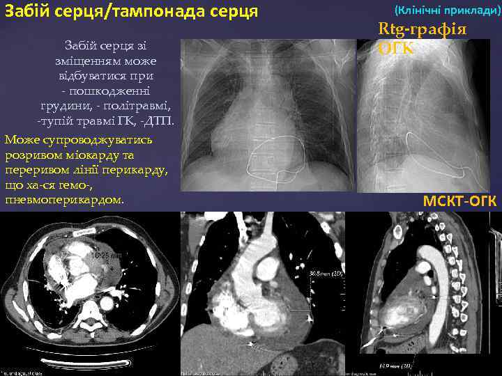 Забій серця/тампонада серця Забій серця зі зміщенням може відбуватися при - пошкодженні грудини, -