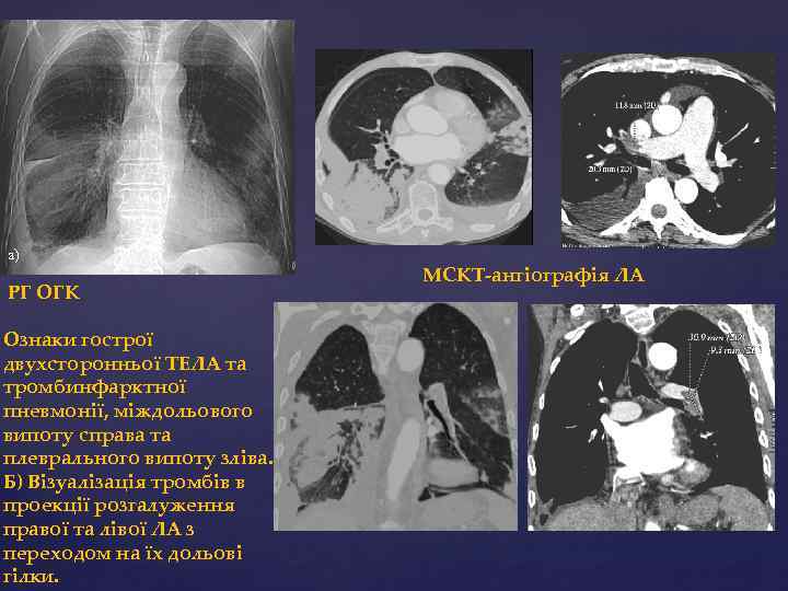 а) РГ ОГК Ознаки гострої двухсторонньої ТЕЛА та тромбинфарктної пневмонії, міждольового випоту справа та