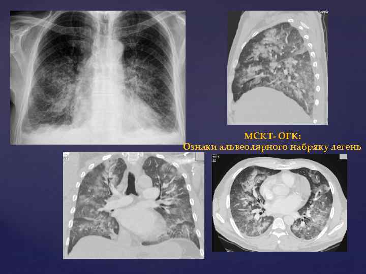 МСКТ- ОГК: Ознаки альвеолярного набряку легень 