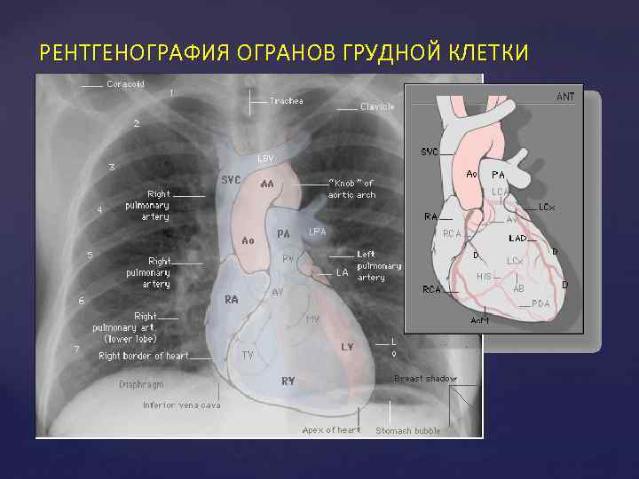 РЕНТГЕНОГРАФИЯ ОГРАНОВ ГРУДНОЙ КЛЕТКИ 