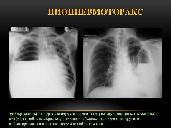 На рентгенологической картине напряженного пиопневмоторакса отмечается смещение средостения в