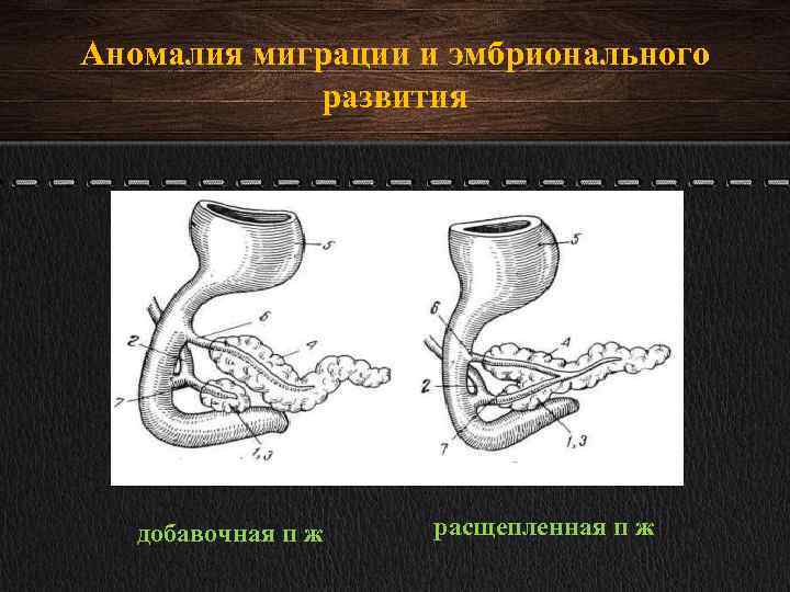 Аномалия миграции и эмбрионального развития добавочная п ж расщепленная п ж 