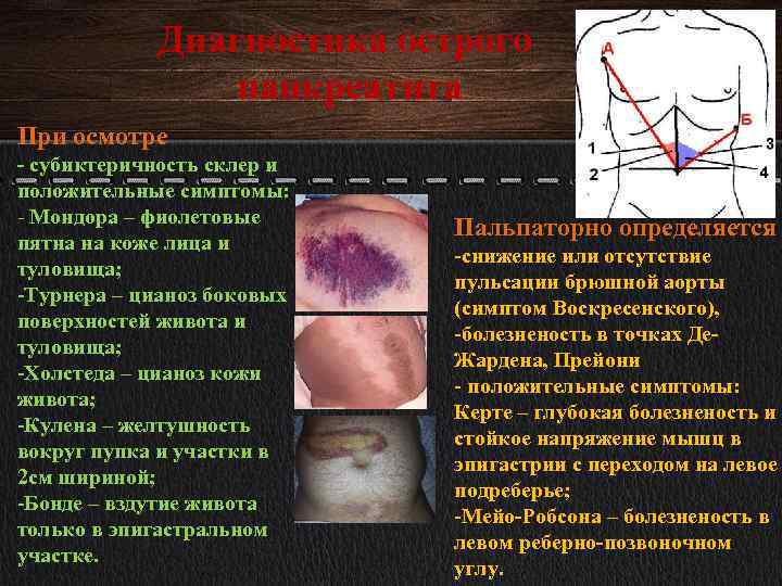 Диагностика острого панкреатита При осмотре - субиктеричность склер и положительные симптомы: - Мондора –