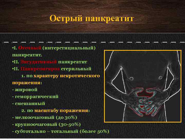 Острый панкреатит • I. Отечный (интерстициальный) панкреатит. • II. Эксудативный панкреатит • II. Панкреонекроз