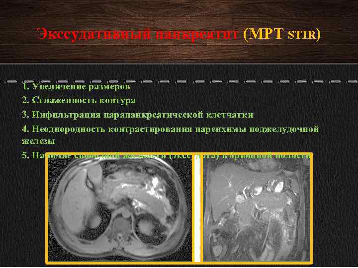 Экссудативный панкреатит (МРТ STIR) 1. Увеличение размеров 2. Сглаженность контура 3. Инфильтрация парапанкреатической клетчатки