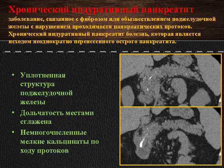 Хронический индуративный панкреатит заболевание, связанное с фиброзом или обызвествлением поджелудочной железы с нарушением проходимости