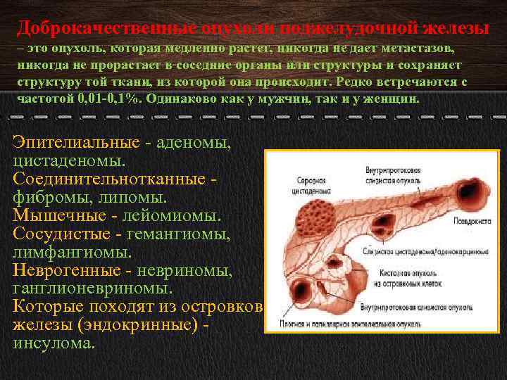 Доброкачественные опухоли поджелудочной железы – это опухоль, которая медленно растет, никогда не дает метастазов,