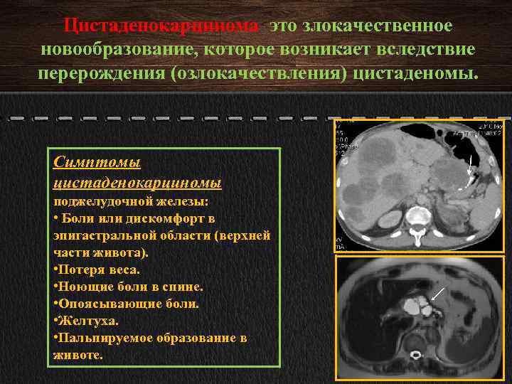 Цистаденокарцинома это злокачественное новообразование, которое возникает вследствие перерождения (озлокачествления) цистаденомы. Симптомы цистаденокарциномы поджелудочной железы: