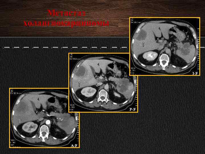 Метастаз холангиокарциномы I-F P-F A-F 