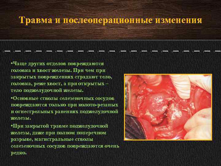 Травма и послеоперационные изменения • Чаще других отделов повреждаются головка и хвост железы. При