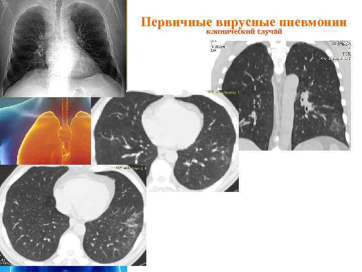 Первичные вирусные пневмонии клинический случай 