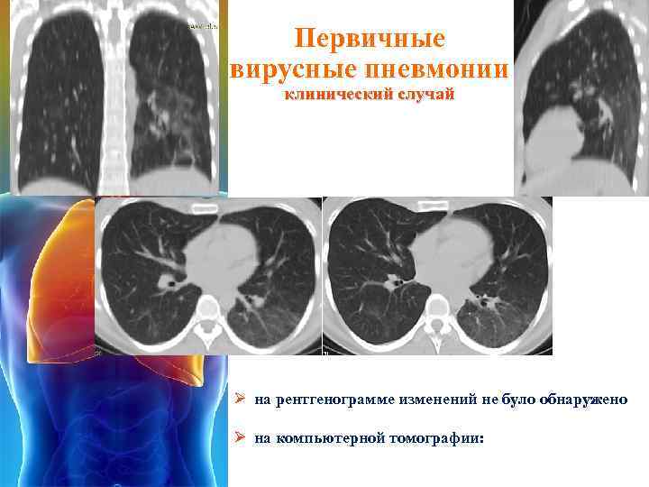 Первичные вирусные пневмонии клинический случай Ø на рентгенограмме изменений не було обнаружено Ø на