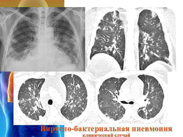 Вирусно-бактериальная пневмония клинический случай 