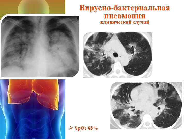 Вирусно-бактериальная пневмония клинический случай Ø Sp. O 2 88% 