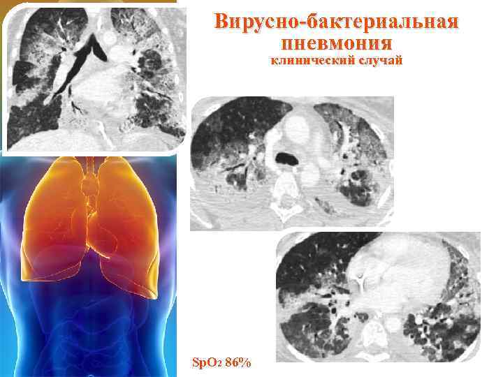 Вирусно-бактериальная пневмония клинический случай Sp. O 2 86% 