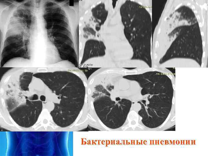 Чем отличается пневмония от ковида 19. Бактериальная пневмония на кт легких. Ковидная пневмония на кт. Микоплазменная пневмония на кт. Пневмоцистная пневмония на кт.