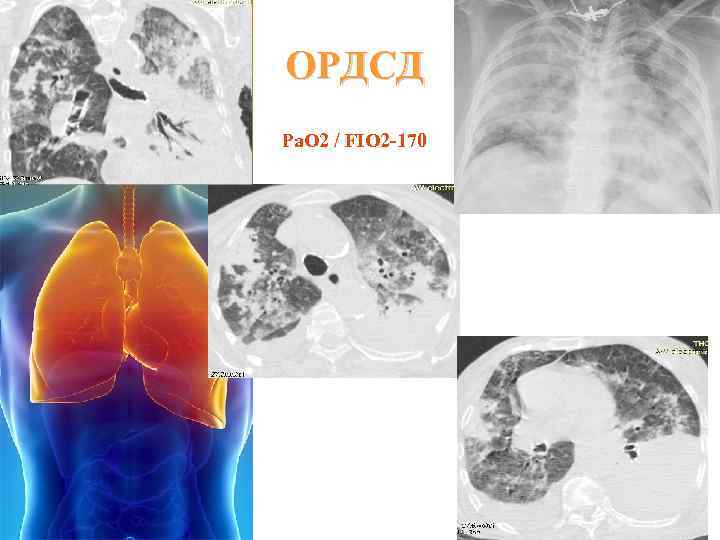 ОРДСД Pa. O 2 / FIO 2 -170 