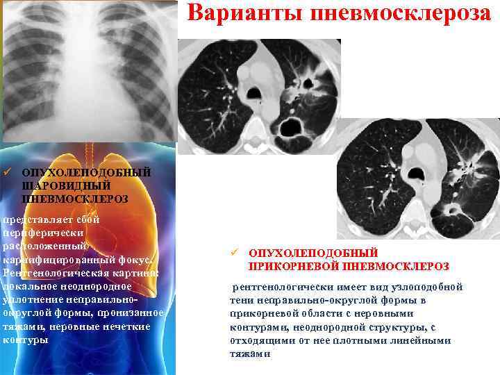 Пневмосклероз это простыми словами. Пневмосклероз рентген описание. Пневмосклероз кт признаки. Диффузный пневмосклероз кт.