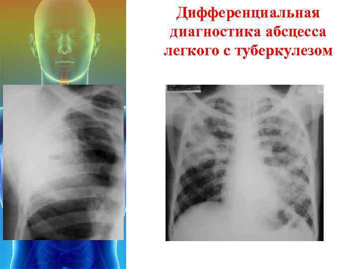 Дифференциальная диагностика абсцесса легкого с туберкулезом 