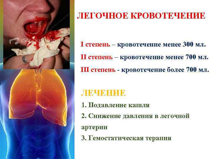  ЛЕГОЧНОЕ КРОВОТЕЧЕНИЕ I степень – кровотечение менее 300 мл. ІІ степень – кровотечение