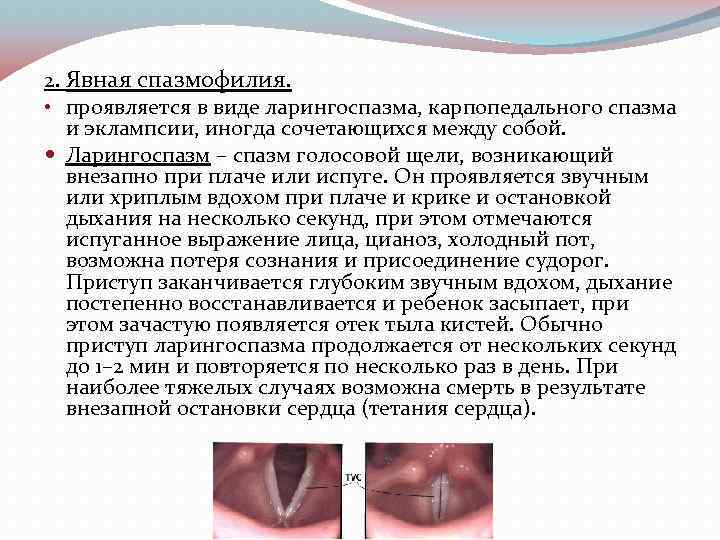 2. Явная спазмофилия. • проявляется в виде ларингоспазма, карпопедального спазма и эклампсии, иногда сочетающихся