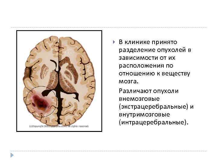  В клинике принято разделение опухолей в зависимости от их расположения по отношению к