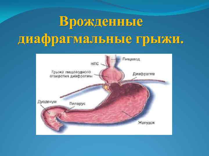 Врожденные диафрагмальные грыжи. 