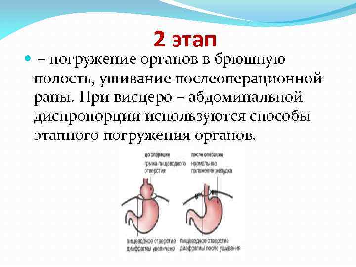 2 этап – погружение органов в брюшную полость, ушивание послеоперационной раны. При висцеро –