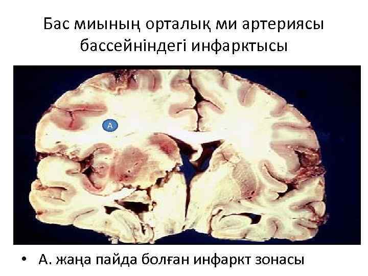 Бас миының орталық ми артериясы бассейніндегі инфарктысы А • А. жаңа пайда болған инфаркт