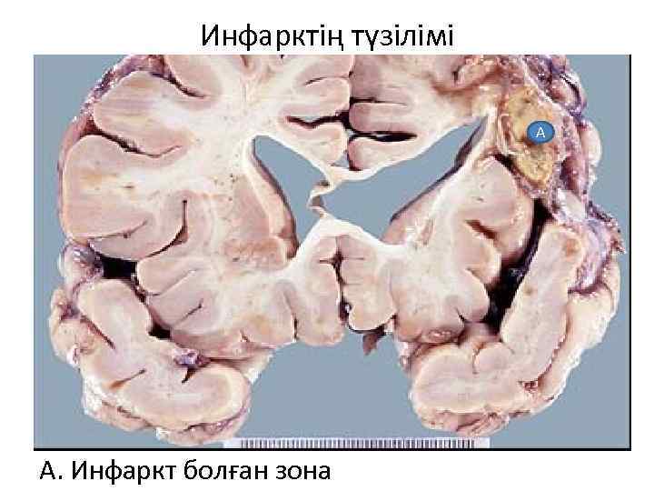 Инфарктің түзілімі А А. Инфаркт болған зона 