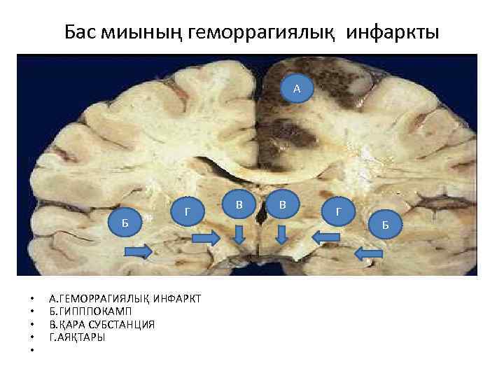 Бас миының геморрагиялық инфаркты А Б • • • Г А. ГЕМОРРАГИЯЛЫҚ ИНФАРКТ Б.