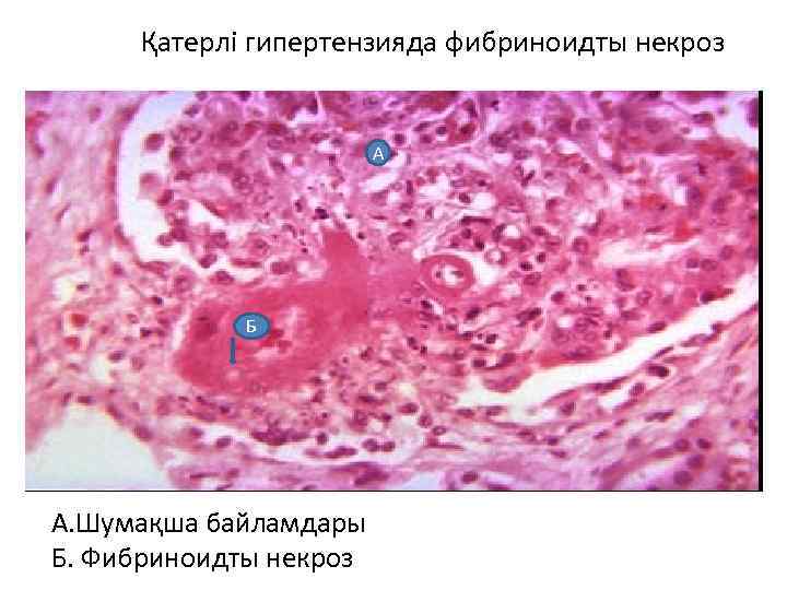 Қатерлі гипертензияда фибриноидты некроз А Б А. Шумақша байламдары Б. Фибриноидты некроз 