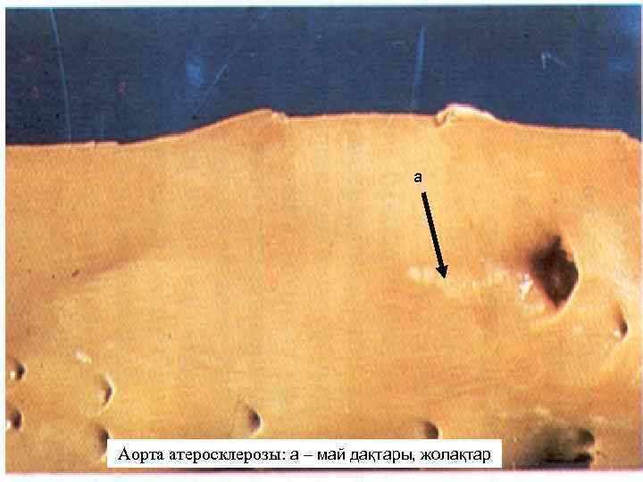 а Атеросклероз аорты: а – жировые пятна, жолақтар Аорта атеросклерозы: а – май дақтары,