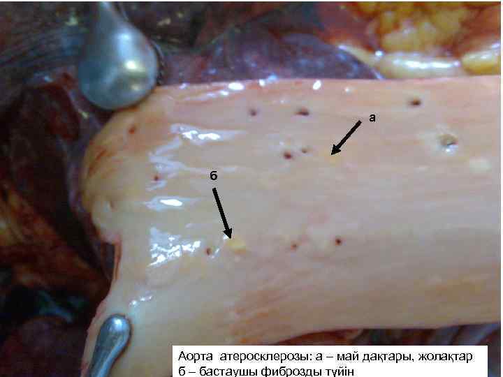 а б Аорта атеросклерозы: а – май дақтары, жолақтар б – бастаушы фиброзды түйін