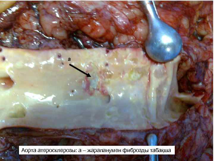 а Аорта атеросклерозы: - фиброзная бляшка с изъязвлением Атеросклероз аорты: аа – жараланумен фиброзды